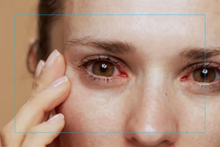A facial close-up of red irritated eyes