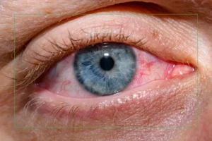 Close up of a red irritated eye