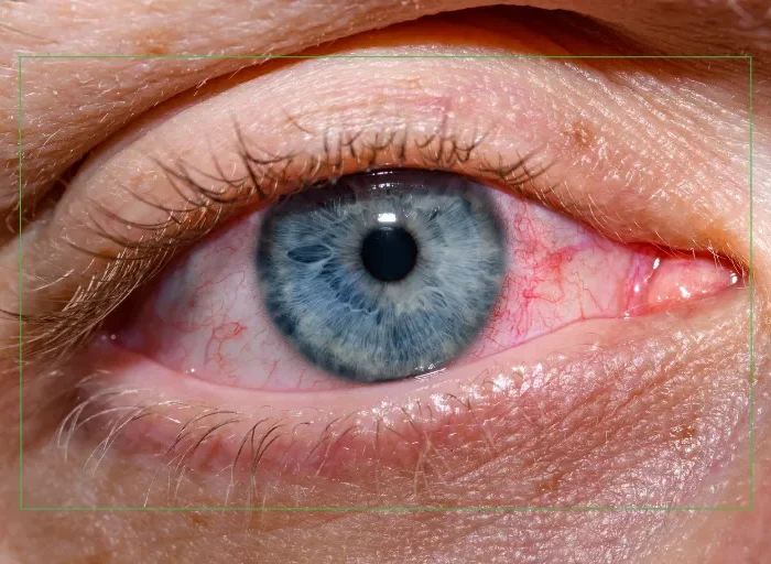 Close up of a red irritated eye