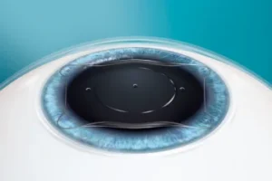 Close up illustration of an eye undergoing the ICL Procedure.