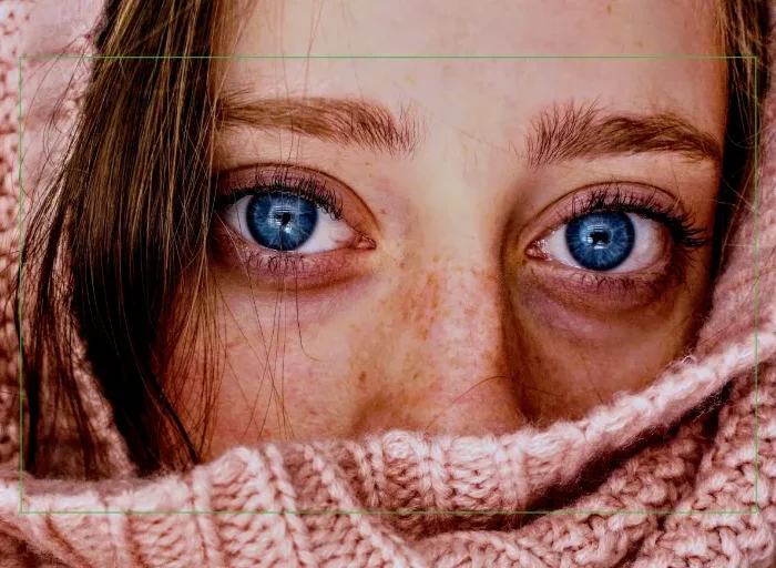 Close-up of irritated blue eyes demonstrating common symptoms of seasonal allergies and dry eye disease in Florida.