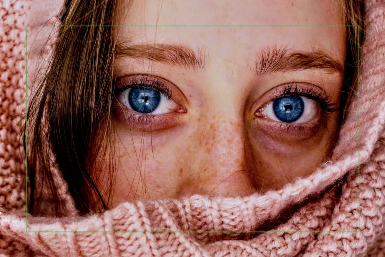 Close-up of irritated blue eyes demonstrating common symptoms of seasonal allergies and dry eye disease in Florida.