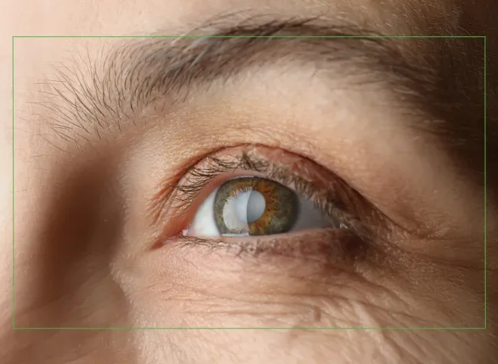 Close-up of an eye with a cataract, highlighting the importance of protecting vision from UV damage and cataract development in Florida.