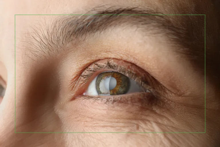Close-up of an eye with a cataract, highlighting the importance of protecting vision from UV damage and cataract development in Florida.